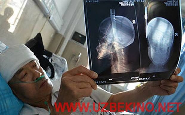 Скрипн Shifokorlar xitoylikning boshidan 8-qavatdan tushib ketgan pichoqni olib tashlashdi(UZBEKINO.NET)